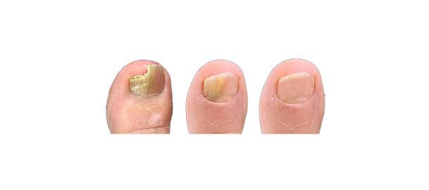 Green Nail Pseudomonas Infection | Fungal Laser Nail Surgery Specialist  Clinic in London